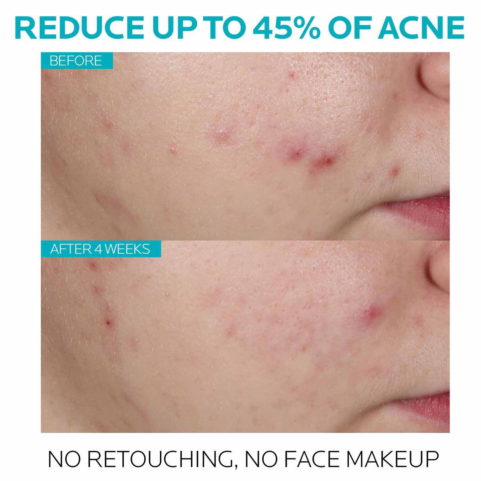 effaclar-salicylic-acid-acne-treatment-serum-h6 7_EffaclarSerum_After-45-days.jpg