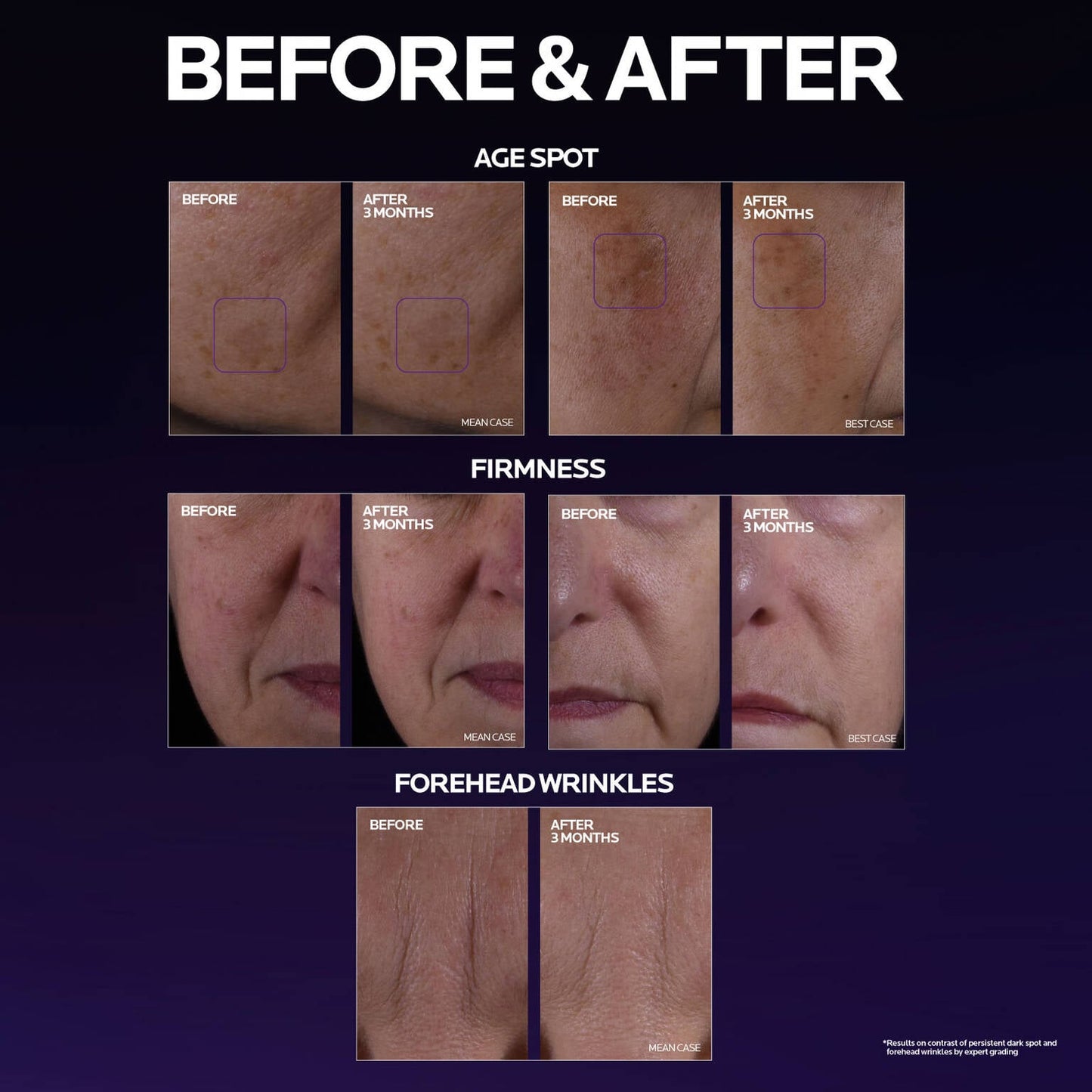 mela-b3-double-dose-discoloration-treatment-with-melasyltm-f3 MelaB3_DD_BTF_BeforeAfter_1500x1500_5.jpg