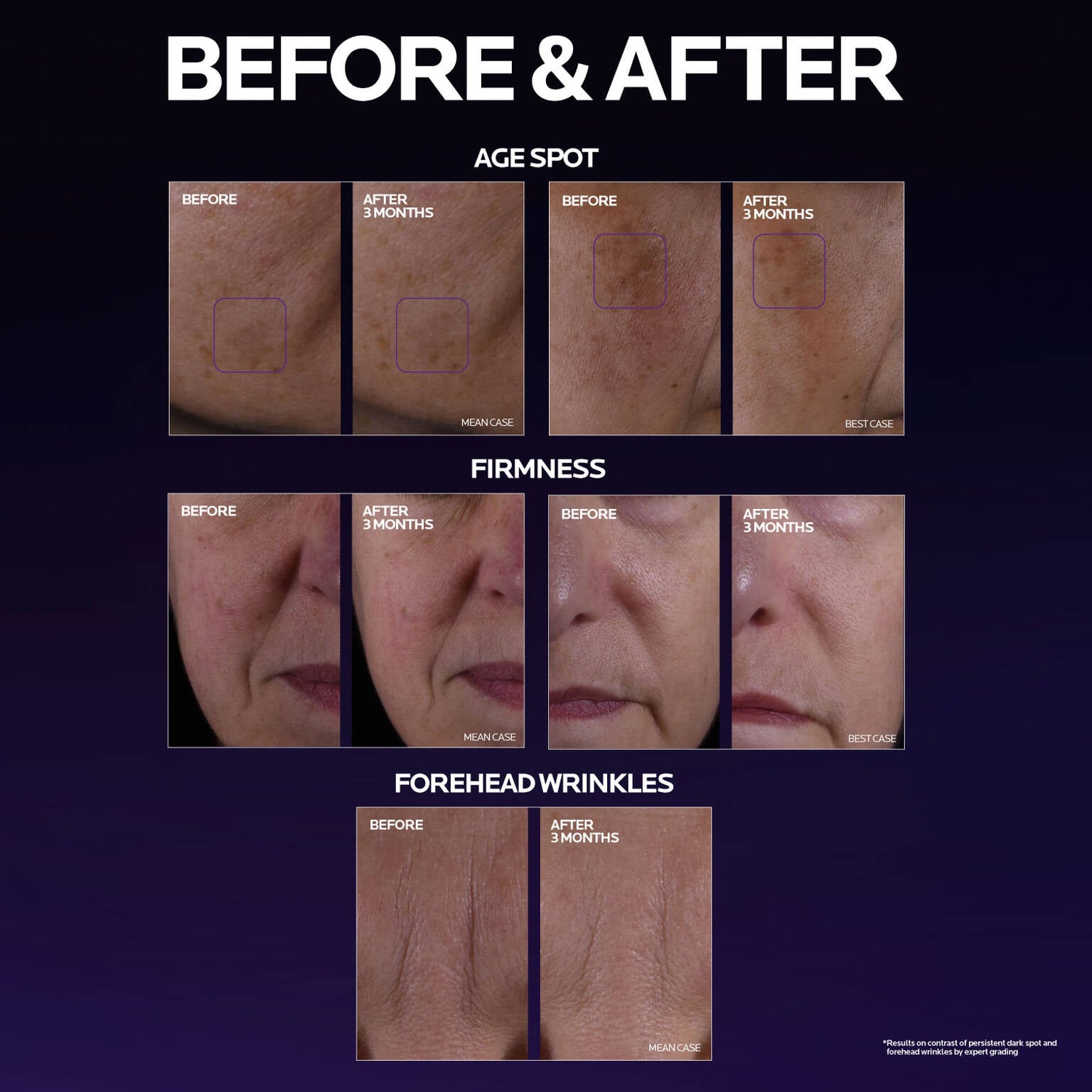 mela-b3-double-dose-discoloration-treatment-with-melasyltm-f3 MelaB3_DD_BTF_BeforeAfter_1500x1500_5.jpg